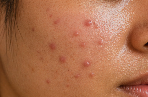 Fungal Acne vs. Regular Acne: How to Know Which One You Have