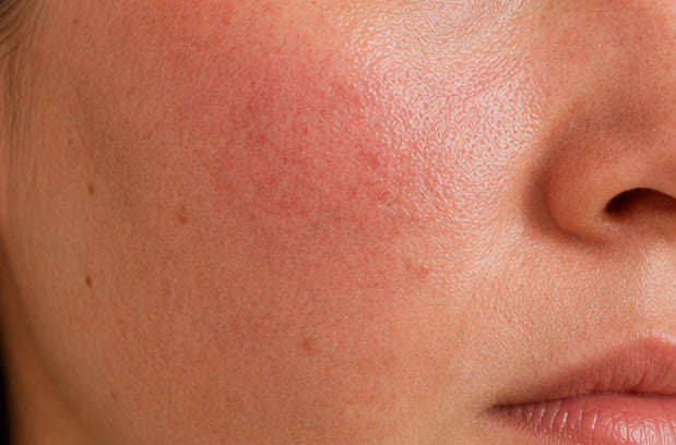 Glycolic Acid vs. Azelaic Acid for Smooth Skin: Surface Polishing vs. Redness Relief