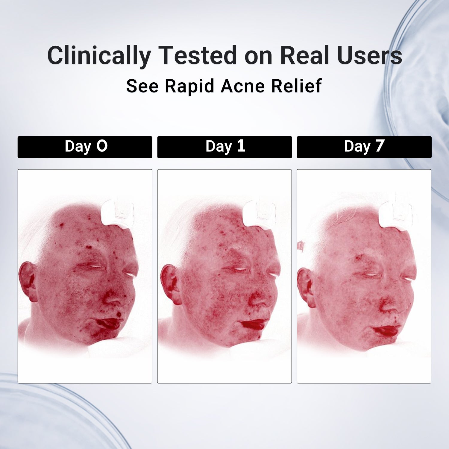 Acne Drying Lotion Plus (1.8% Encapsulated Salicylic Acid) — 20 mL