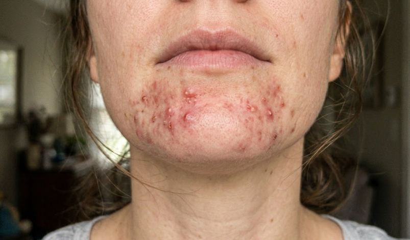 Chin Breakouts & Hormones: How to Clear Stubborn Bumps for Good