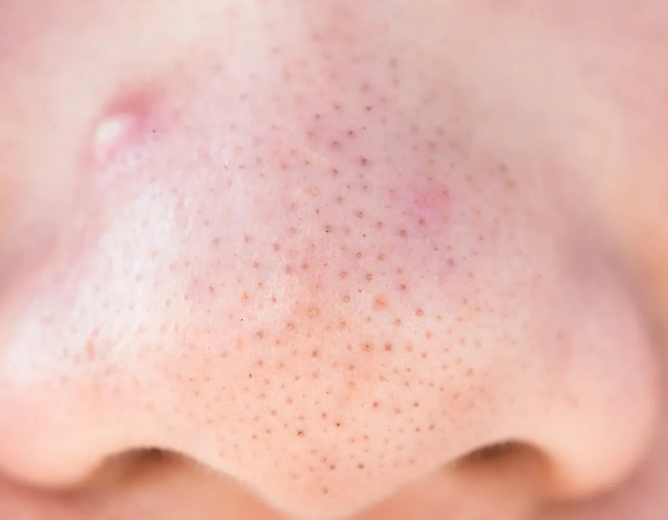 How to Get Rid of Sebaceous Filaments on Your Nose and Chin