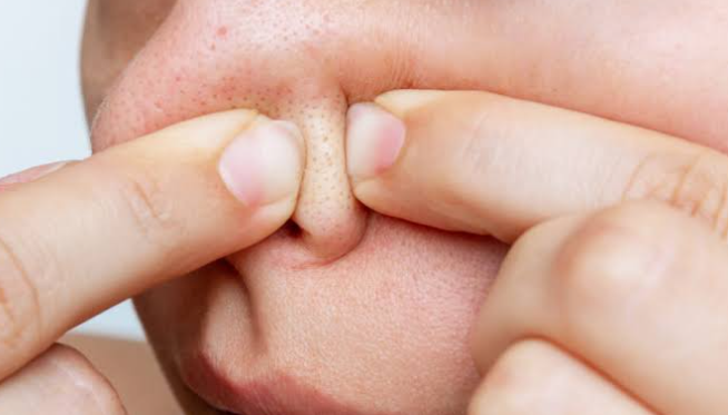 Why Squeezing Sebaceous Filaments Makes Them Worse