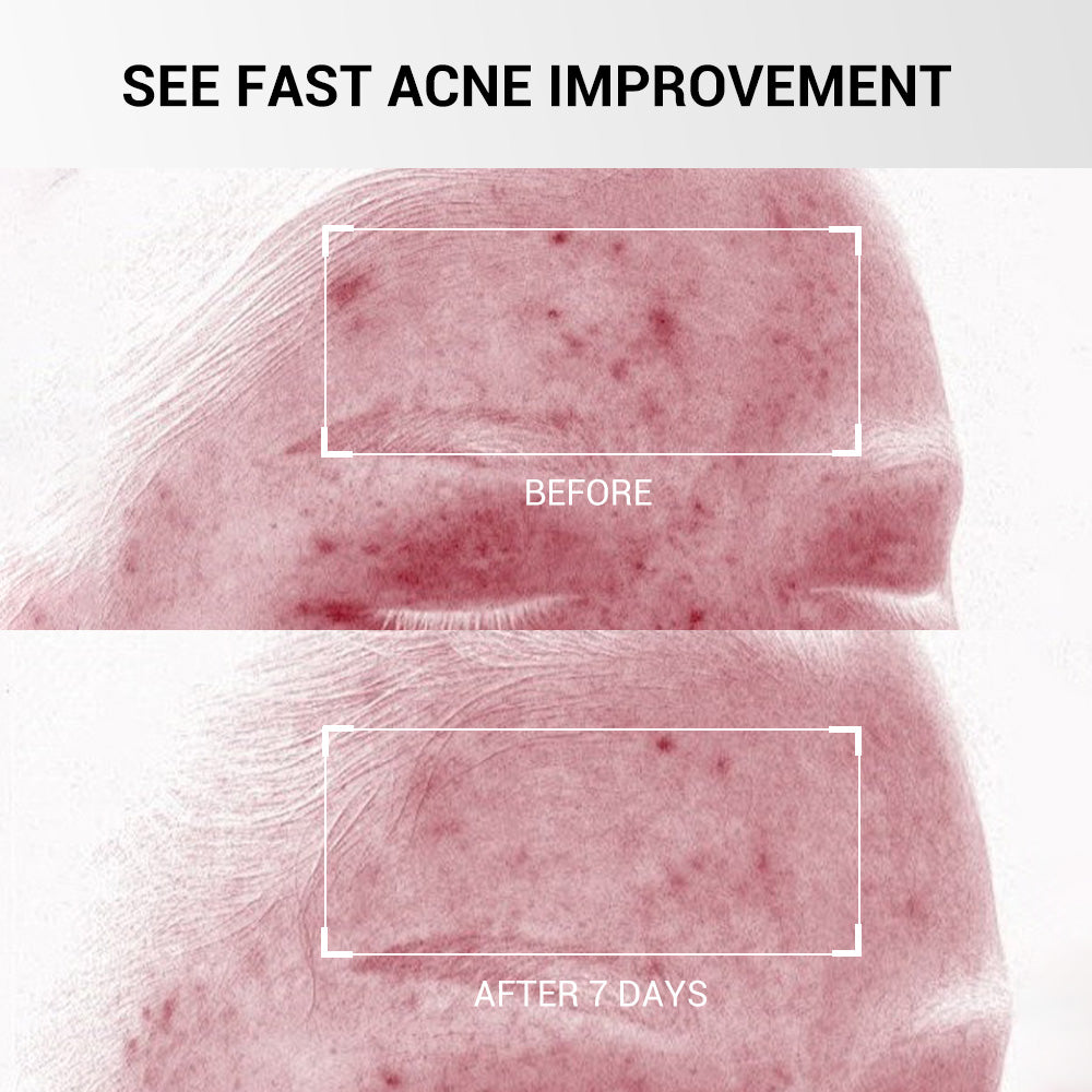 Acne Drying Lotion Plus (1.8% Encapsulated Salicylic Acid) — 20 mL