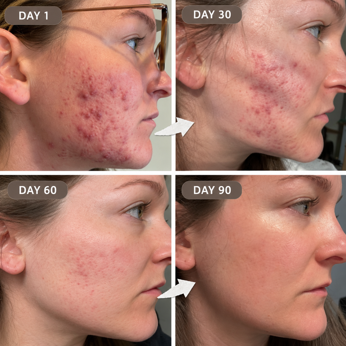 Loción Secante Anti-Acné Plus (1.8% de Ácido Salicílico Encapsulado) — 20 mL