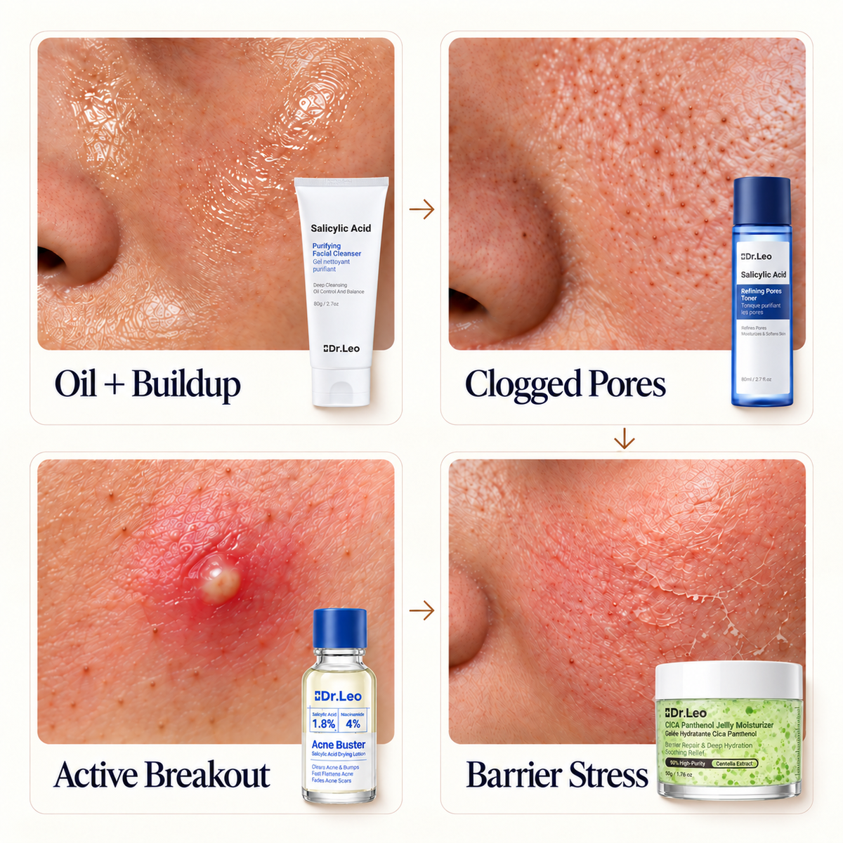 Loción Secante Anti-Acné Plus (1.8% de Ácido Salicílico Encapsulado) — 20 mL